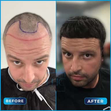 Before and after hair transplant
