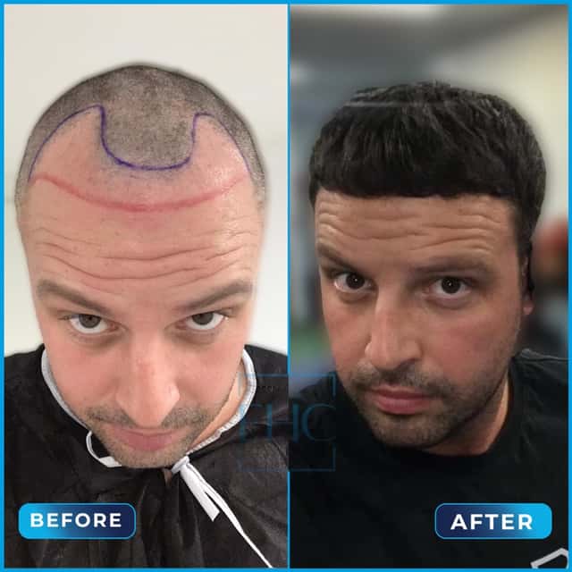 Before and after hair transplant