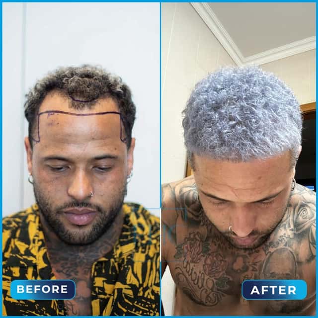 Before and after hair transplant