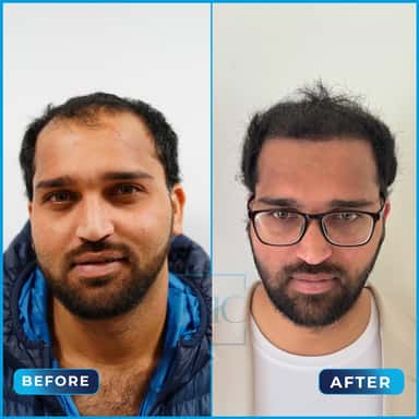 Before and after hair transplant