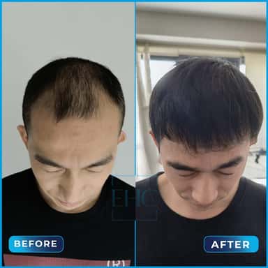 Before and after hair transplant