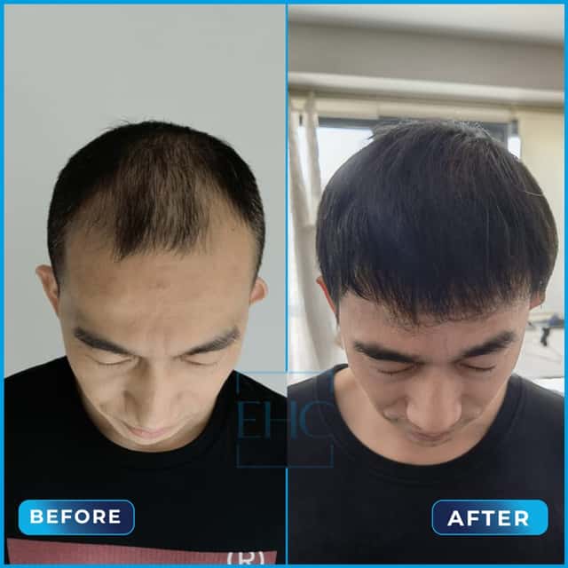Before and after hair transplant