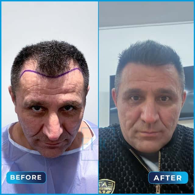 Before and after hair transplant, Cengiz