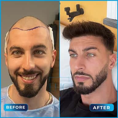 Before and after hair transplant, Daniel