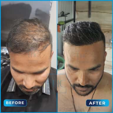 Before and after hair transplant