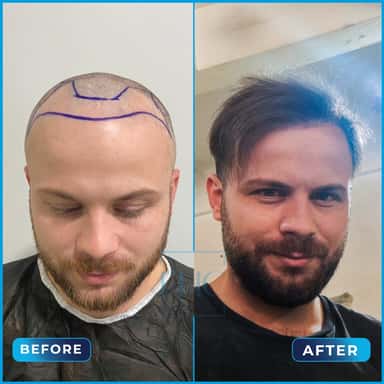 Before and after hair transplant, Erdi