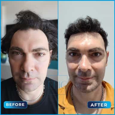 Before and after hair transplant, Francesco
