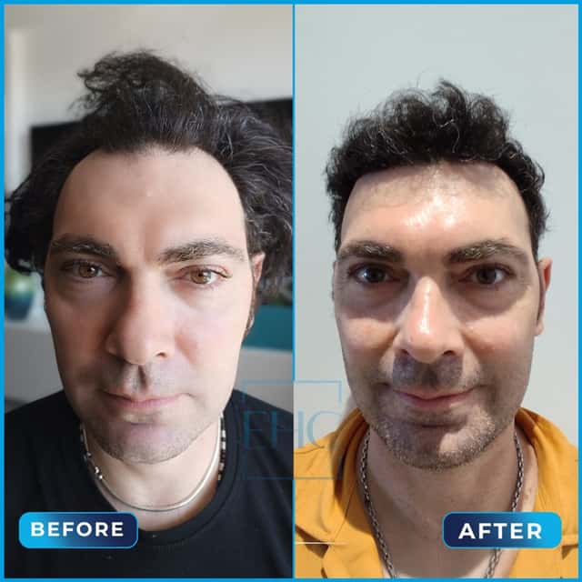 Before and after hair transplant, Francesco