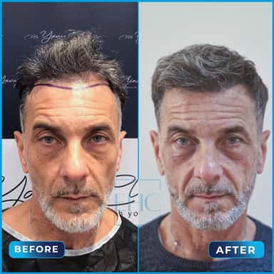 Before and after hair transplant, Gianni