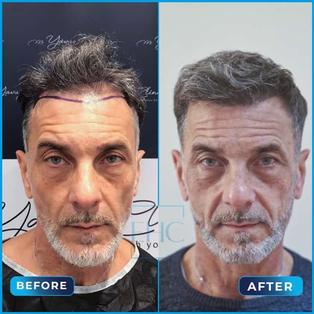 Before and after hair transplant, Gianni