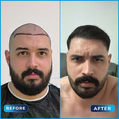 Before and after hair transplant, İsmail