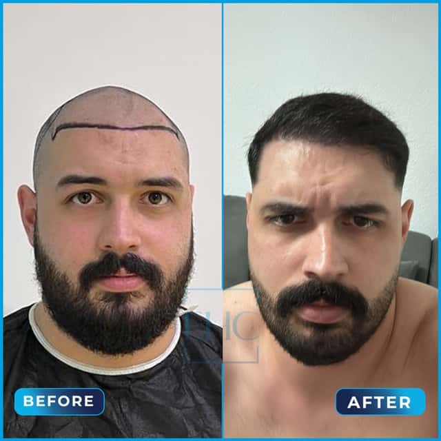 Before and after hair transplant, İsmail