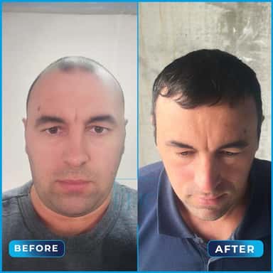 Before and after hair transplant, Iulian
