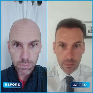 Before and after hair transplant, James