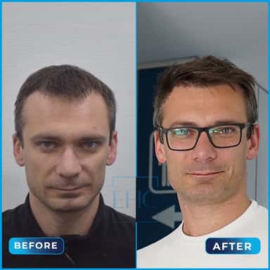 Before and after hair transplant, Maciej