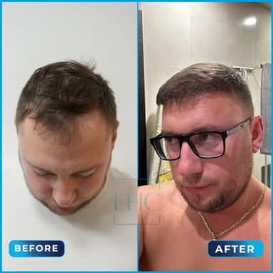 Before and after hair transplant, Maurisuz