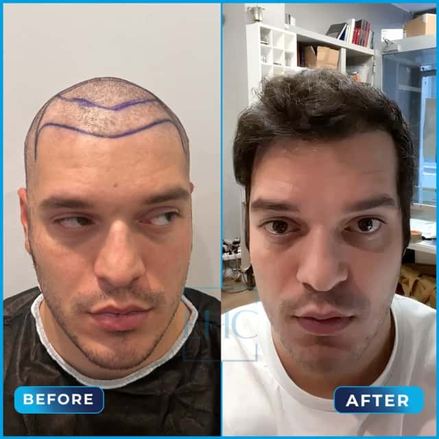 Before and after hair transplant