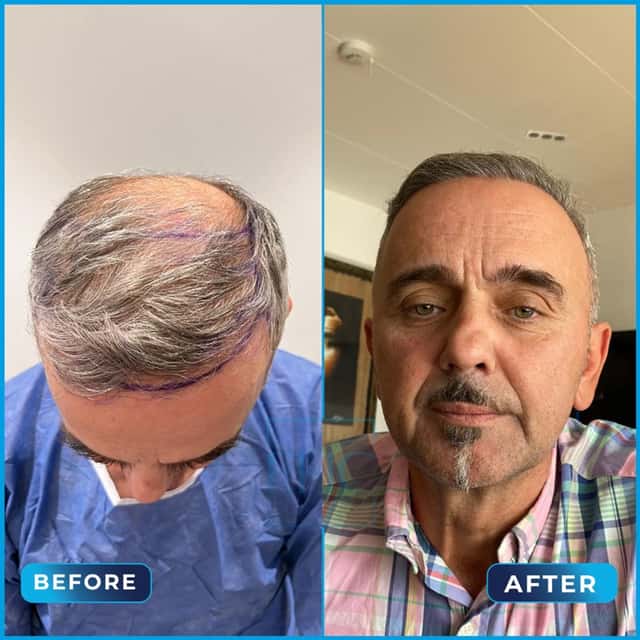 Before and after hair transplant, Mevludin