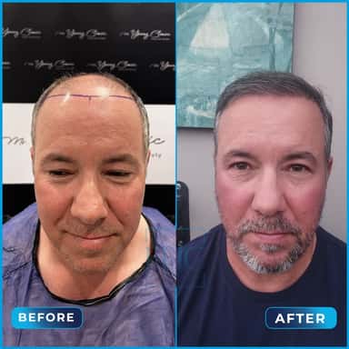 Before and after hair transplant, Michael
