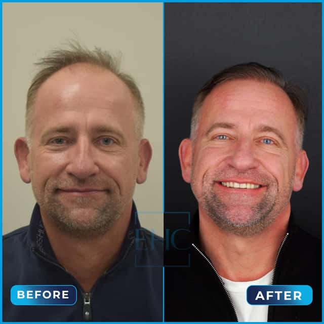 Before and after hair transplant, Mirek