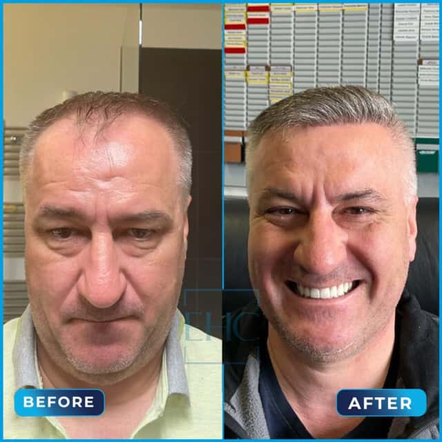 Before and after hair transplant