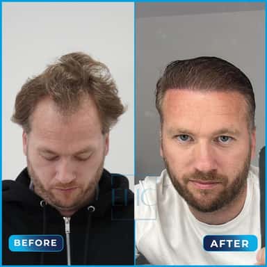 Before and after hair transplant, Ross