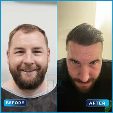 Before and after hair transplant, Thomas