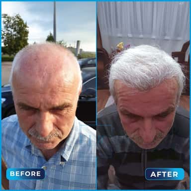 Before and after hair transplant