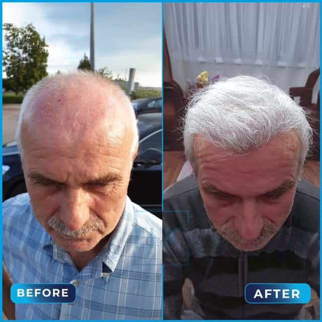 Before and after hair transplant