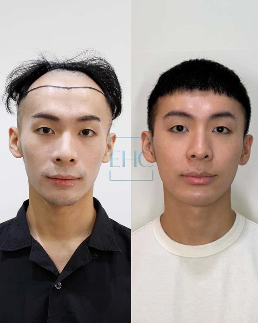 Before and after hair transplant