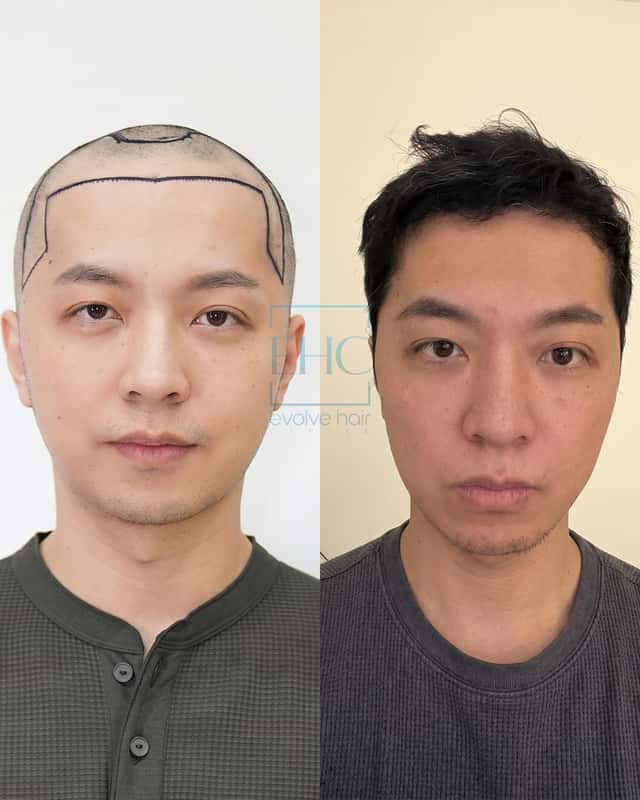 Before and after hair transplant