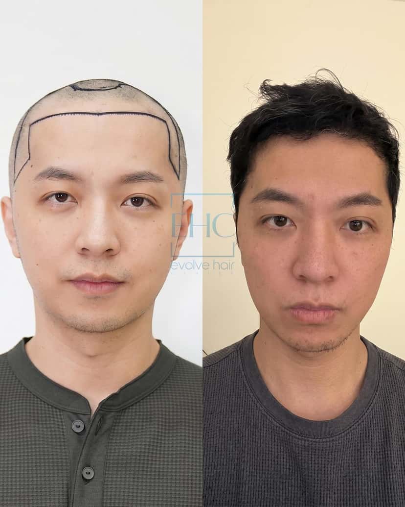 Before and after hair transplant