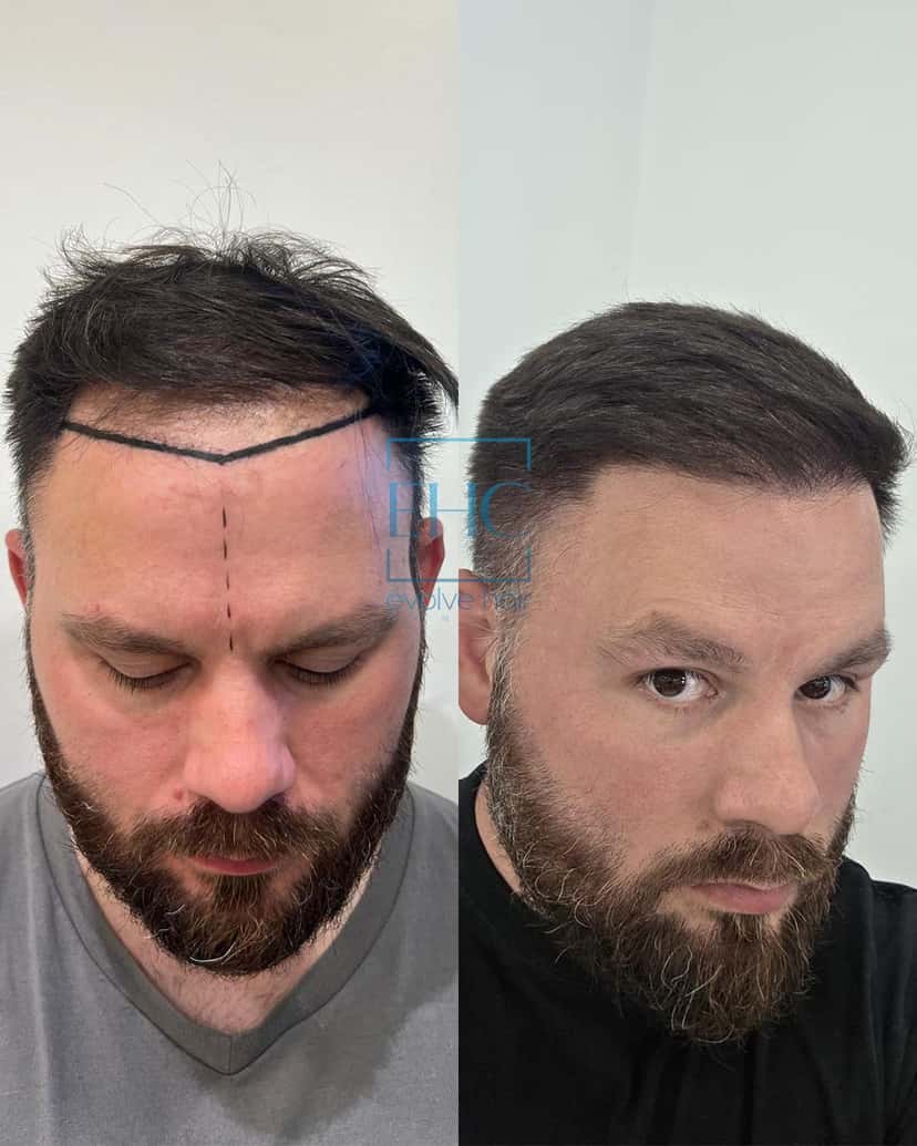Before and after hair transplant