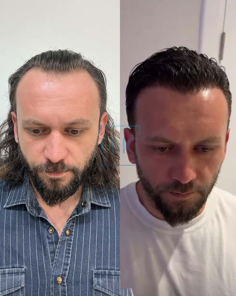 Before and after hair transplant