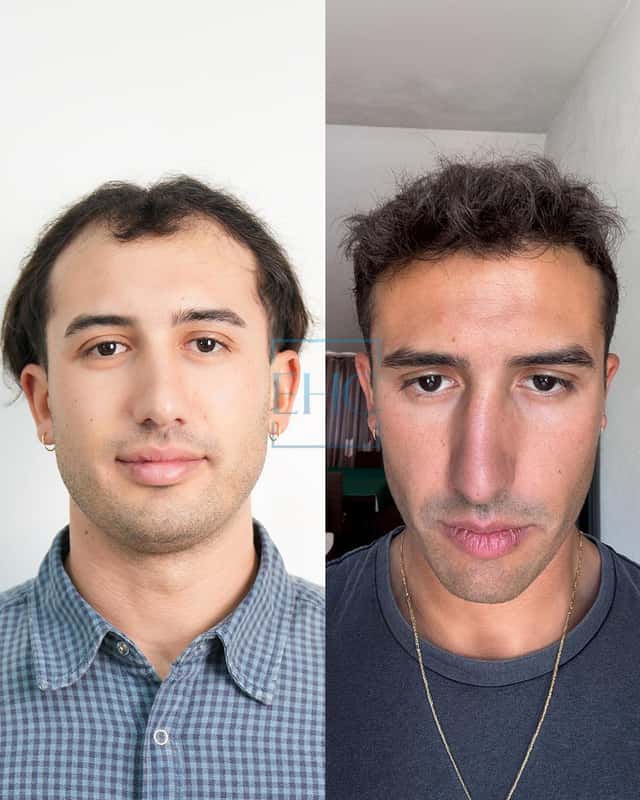 Before and after hair transplant