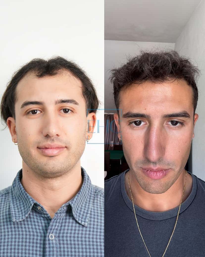 Before and after hair transplant