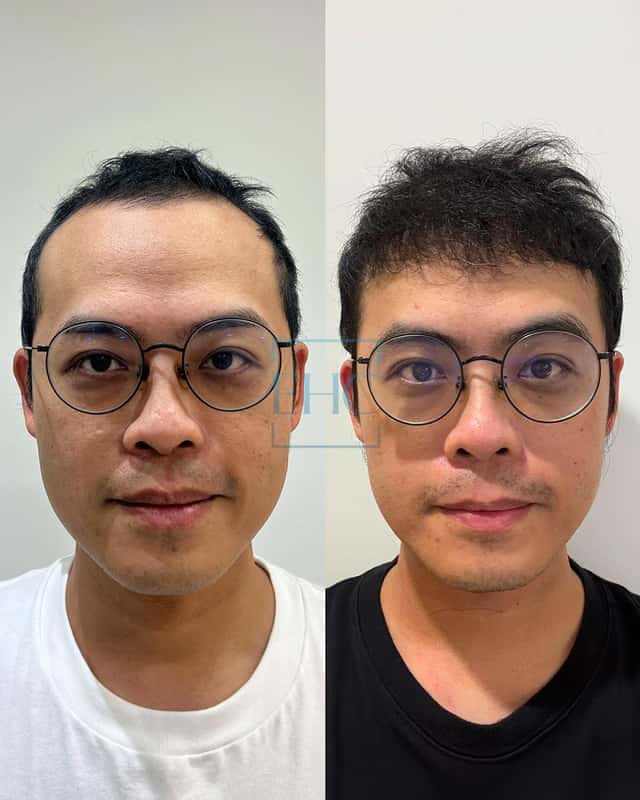 Before and after hair transplant