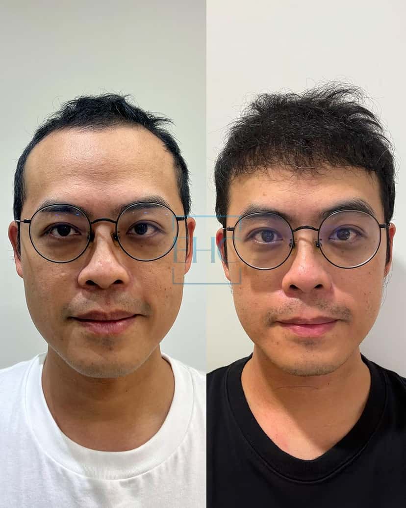 Before and after hair transplant