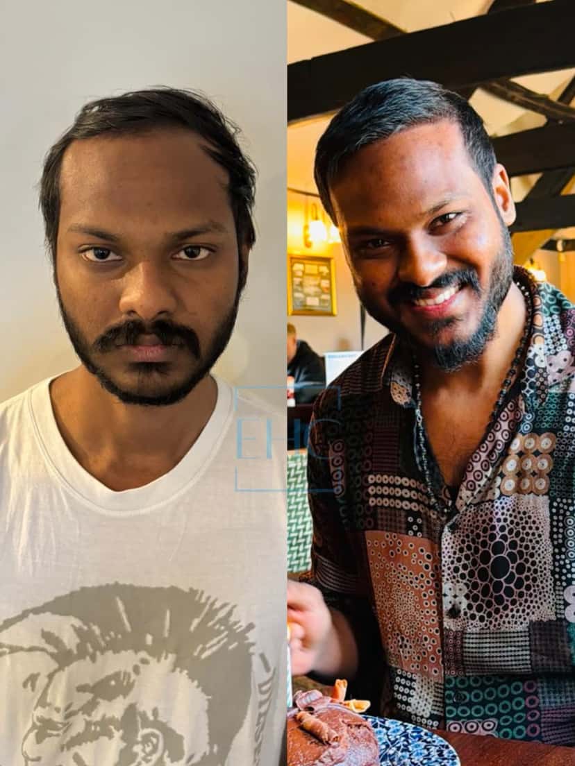 Before and after hair transplant