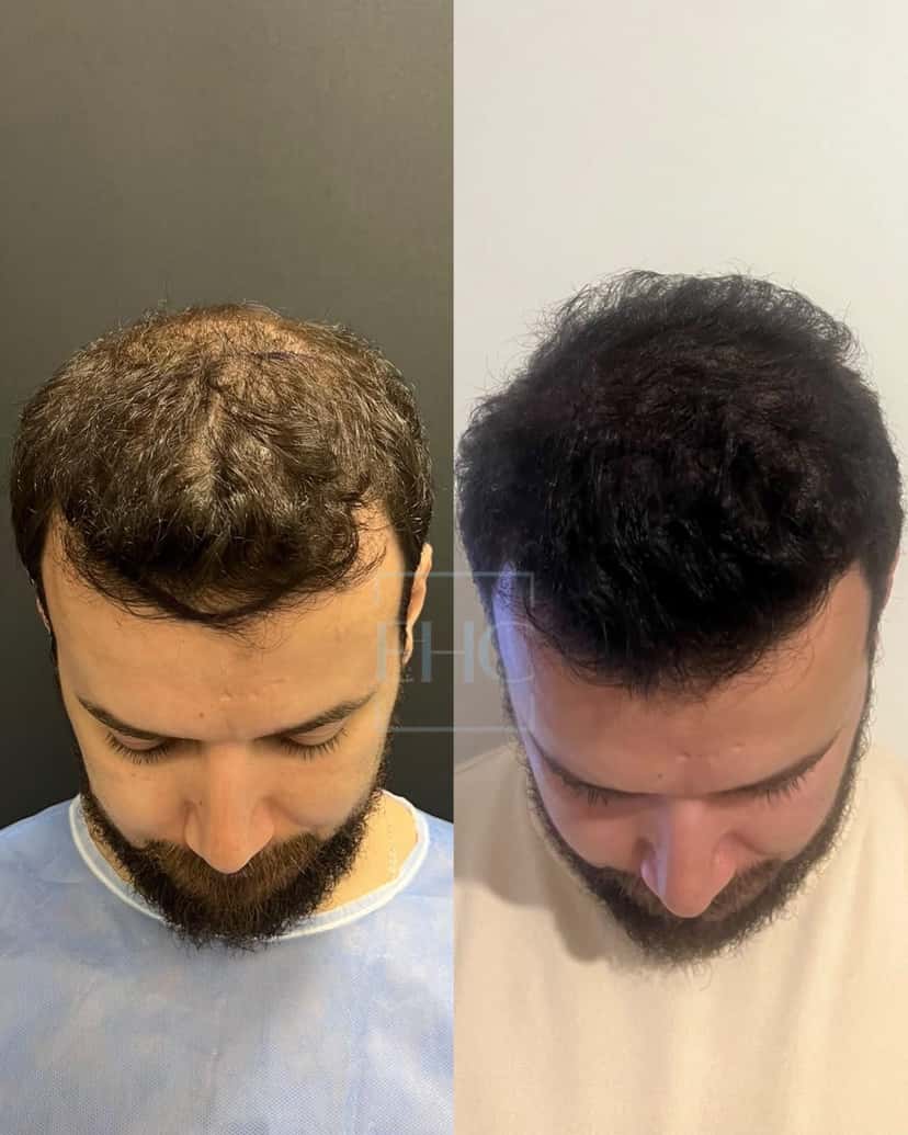 Before and after hair transplant