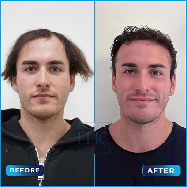 Before and after hair transplant