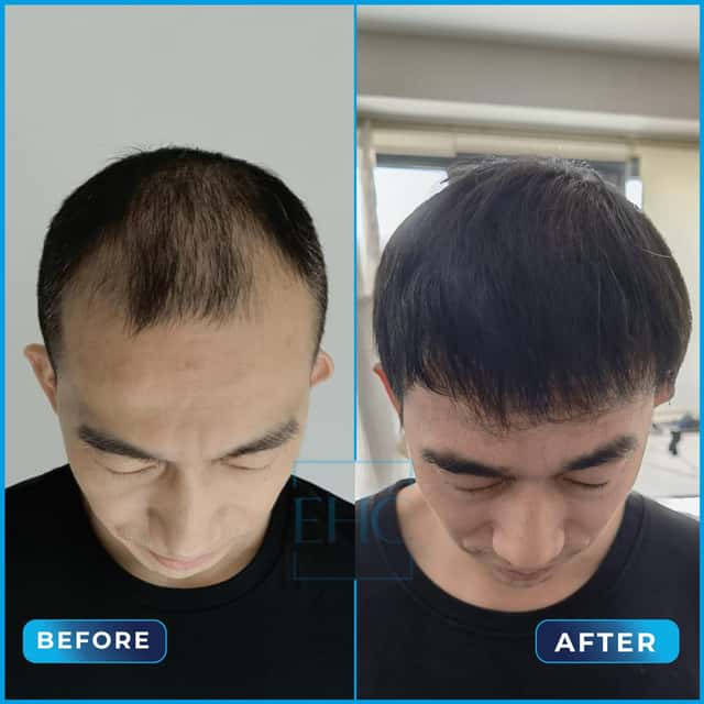 Before and after hair transplant