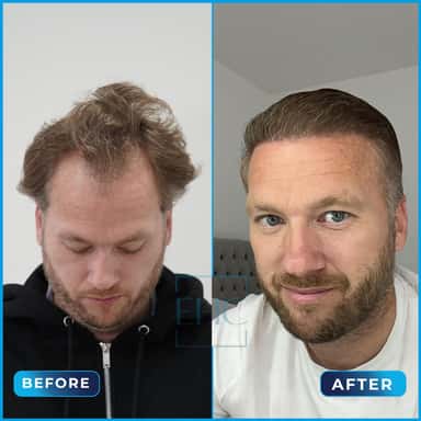 Before and after hair transplant
