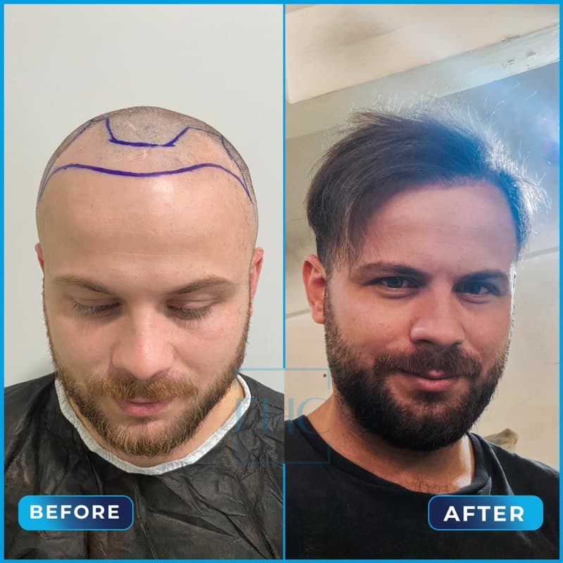 Erdi Yılmaz - Before and After hair transplant