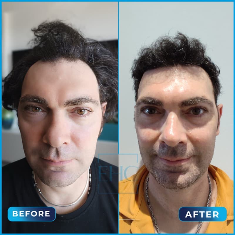 Francesco - Before and After hair transplant