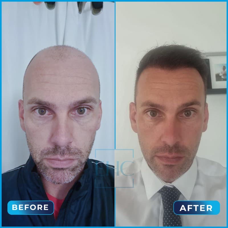 James Auld - Before and After hair transplant