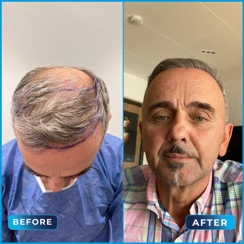 Mevludin - Before and After hair transplant